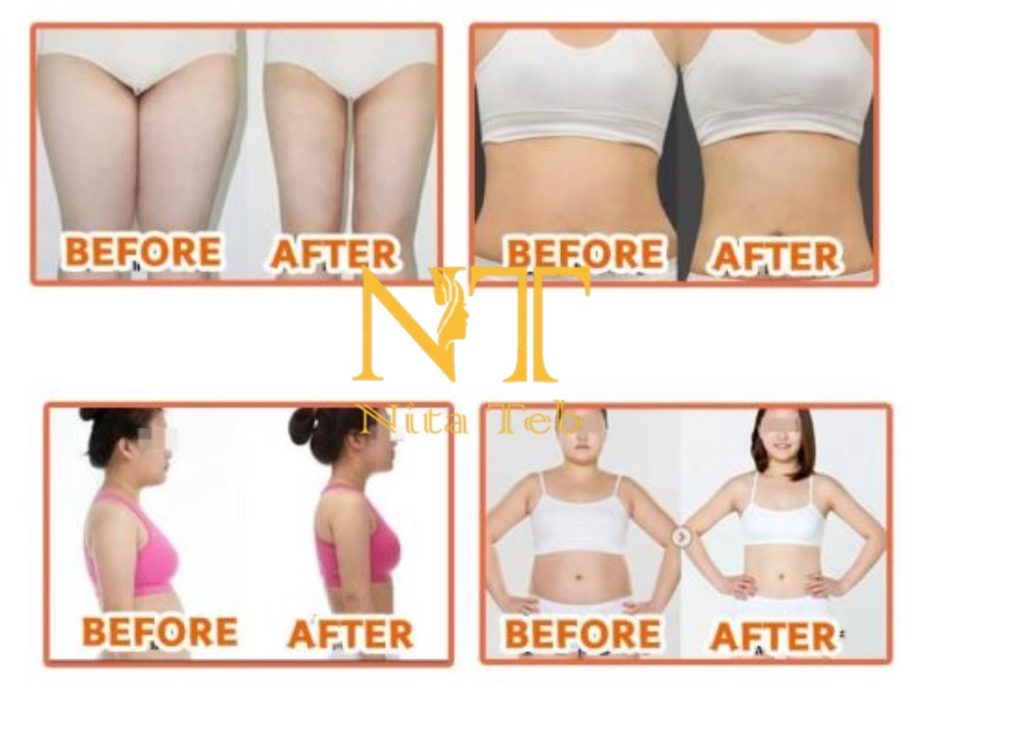 مزو لاغری V Line-A solution
