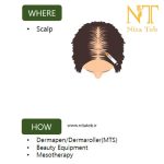 مزو-موی-سر-ویتوکسیدیل-PN-Cell-Vitoxidil